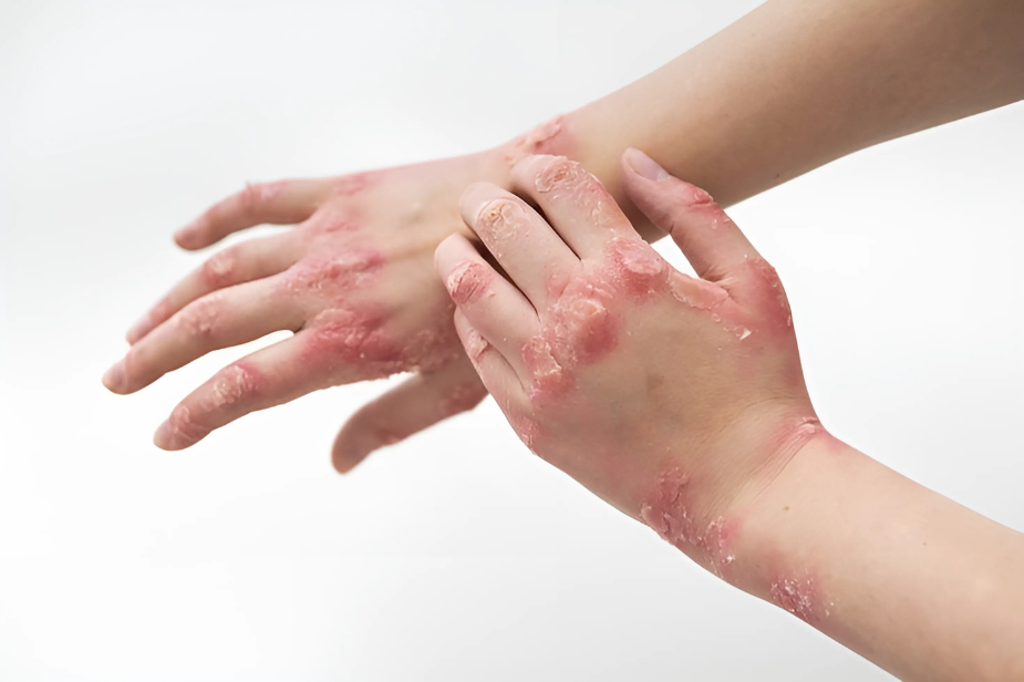 Introduction to Psoriasis